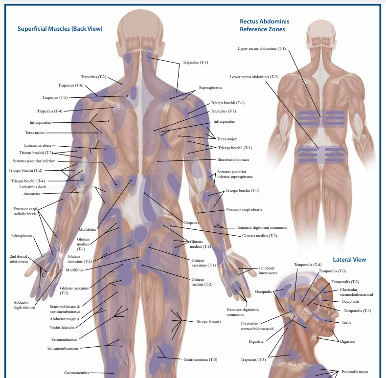 Two Trigger Point Anatomy Maps - Medical Office Wall Poster for Reference by Massage Therapists, Physical Therapists, Chiropractors, Trainers - Pressure Point and Referred Pain Chart (Poster sized) Pack of 2